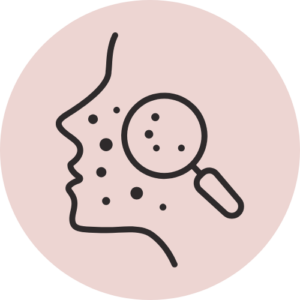 Acne Treatment in Nagpur at Trichoderm Centre