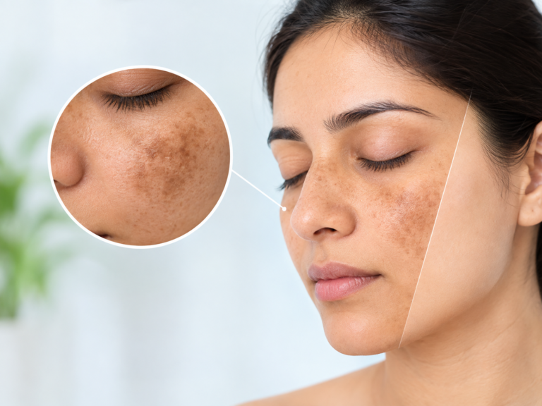 Melasma Treatment in Nagpur at Trichoderm Centre Melasma Treatment in Nagpur: Causes, Triggers & Treatment