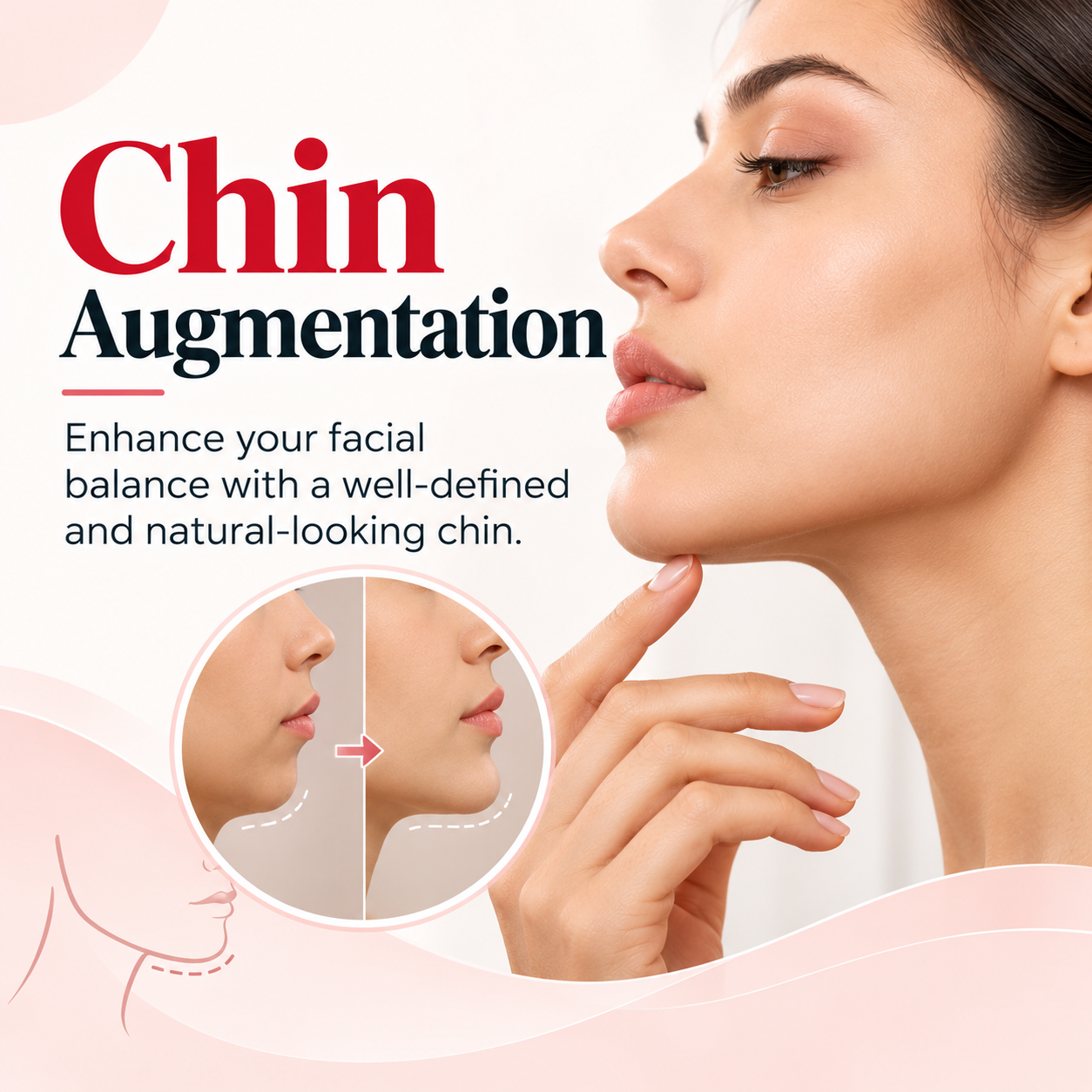 Chin Augmentation