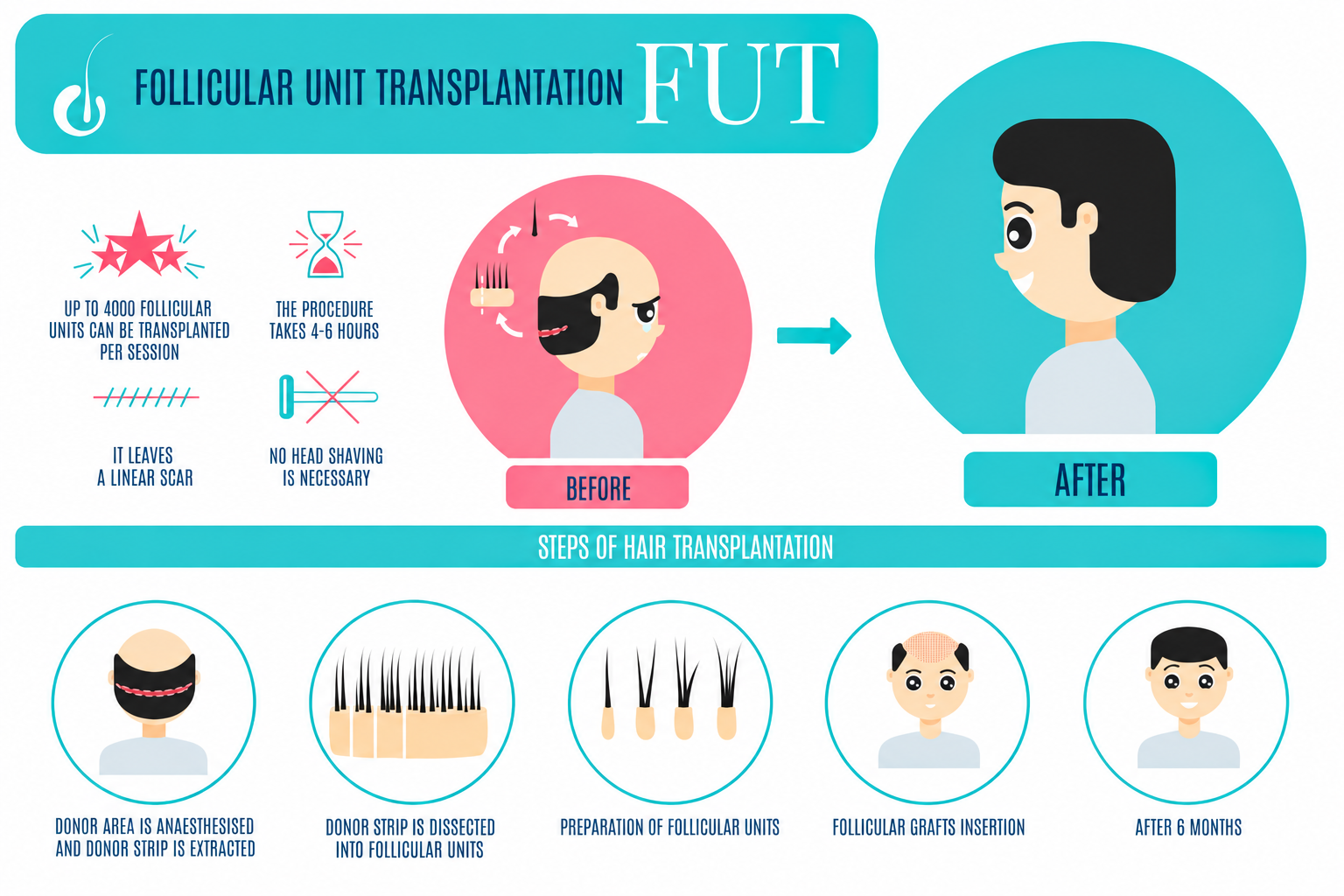 Follicular Unit Transplantation Infographic - Trichoderm Centre Hair & Skin Clinic