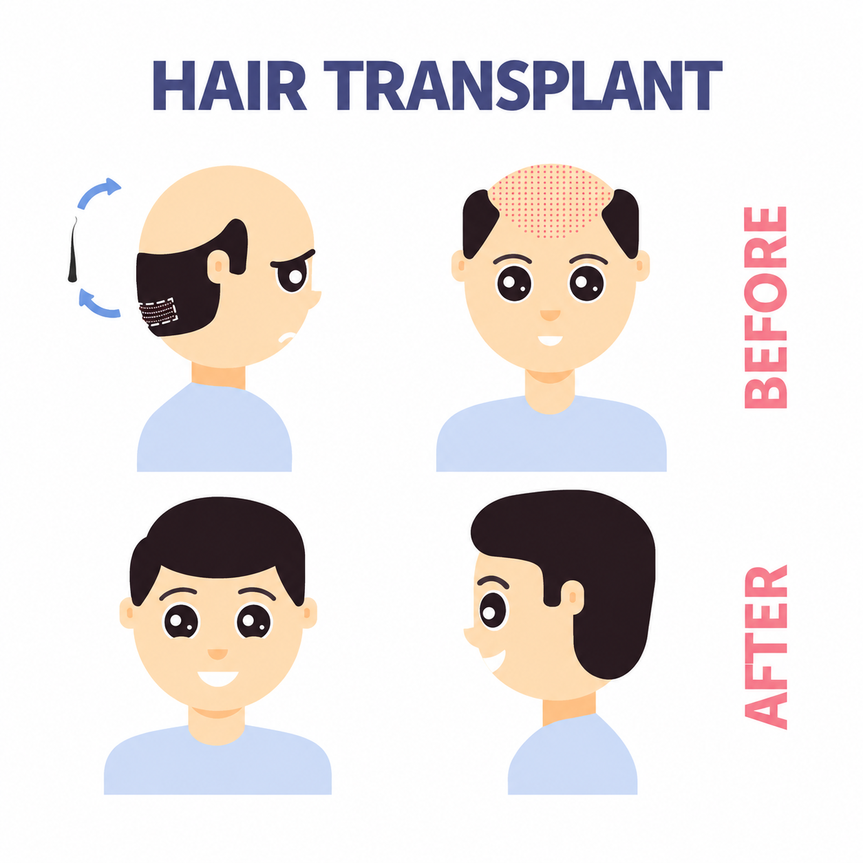 Hair Transplant Before and After Infographic - Trichoderm Centre Hair & Skin Clinic