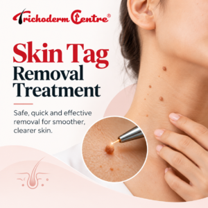 Skin Tag Removal Treatment
