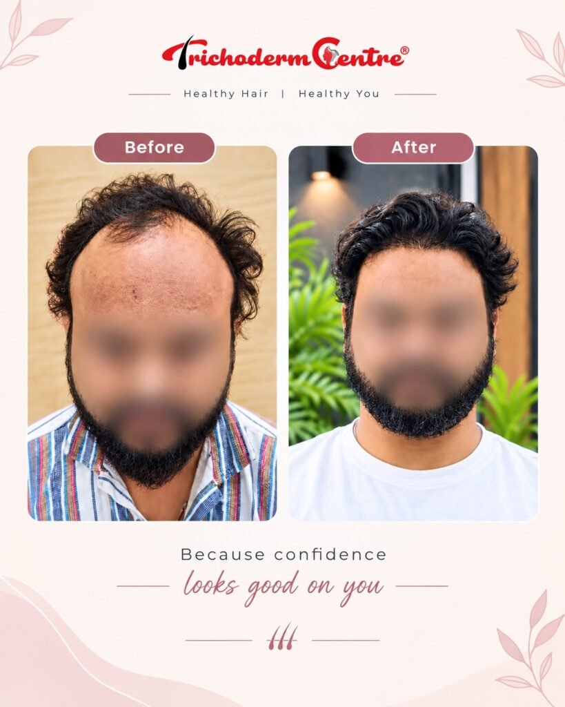 WhatsApp Image 2026 09 29 at 4.56.23 PM 2 - Trichoderm Centre Hair & Skin Clinic